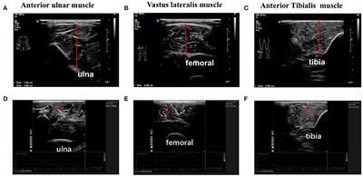 Application of Muscle Thickness and Quality Measured by Ultrasound in Frailty Assessment in China